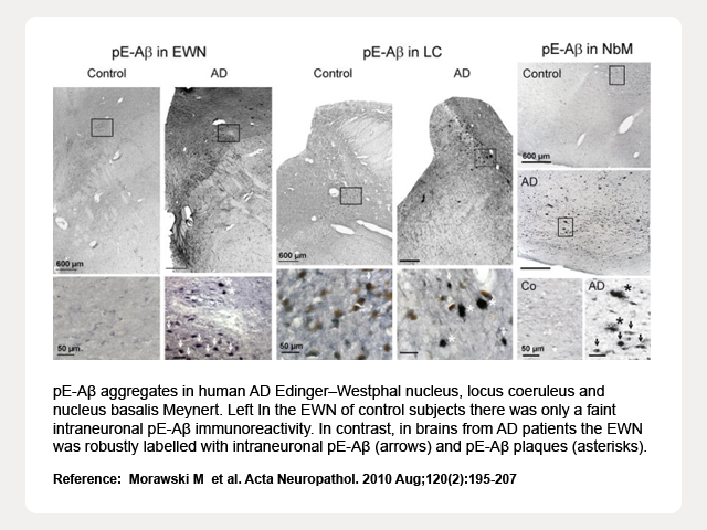 pE-A?aggregates in human AD EdingerWestphal nucleus, locus coeruleus and nucleus basalis Meynert. Left In the EWN of control subjects there was only a faint intraneuronal pE-A?immunoreactivity. In contrast, in brains from AD patients the EWN was robustly labelled with intraneuronal pE-A?(arrows) and pE-A?plaques (asterisks). 